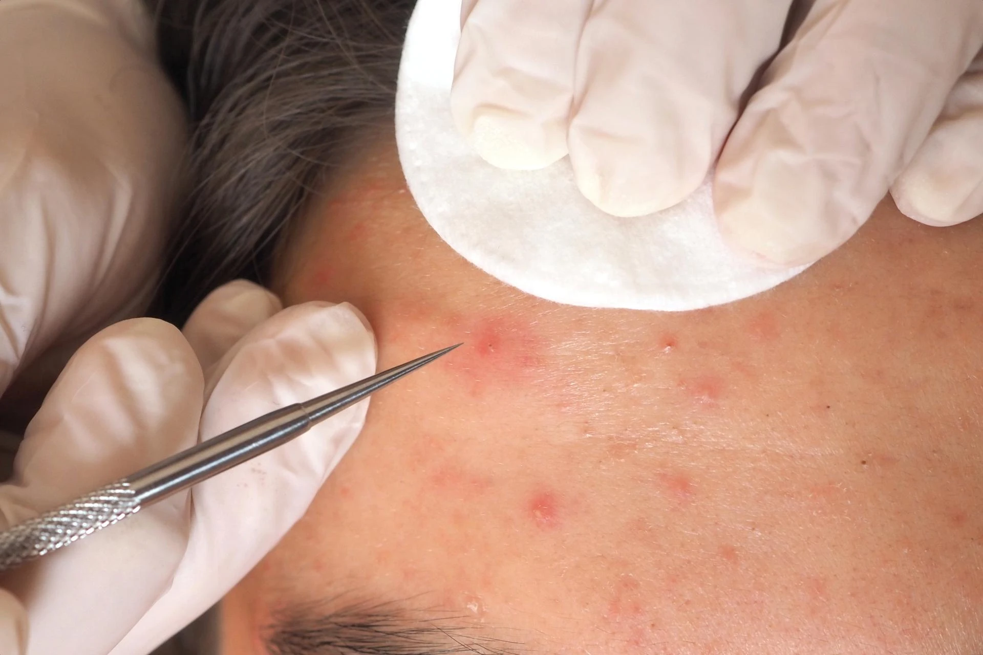 Seborrheic Keratosis Removal